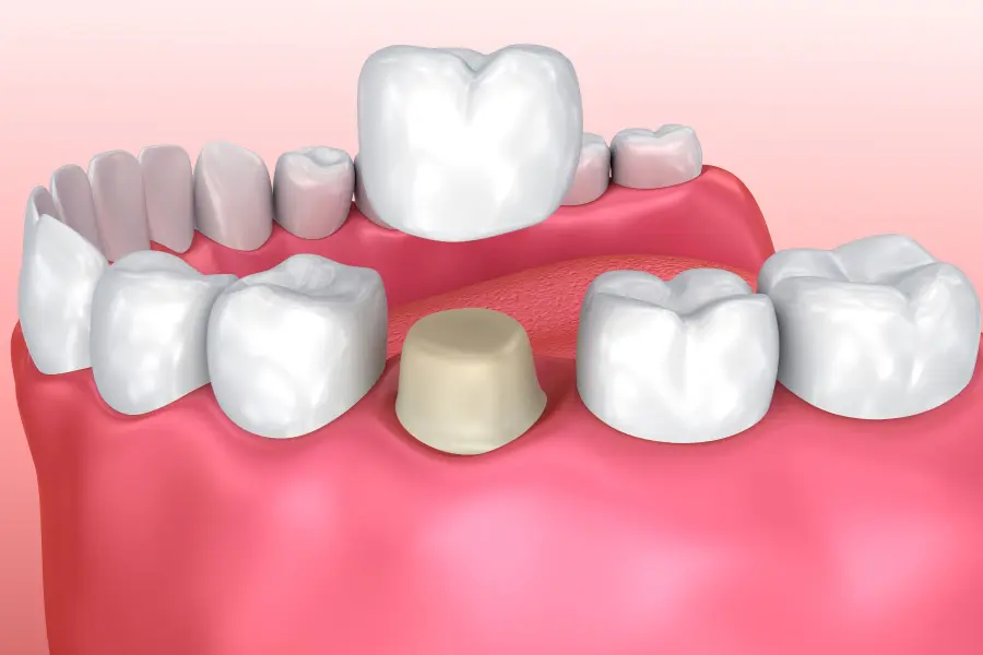 dental crowns